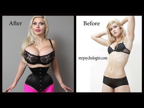 Plastic Surgery and Body Dysmorphic Disorder