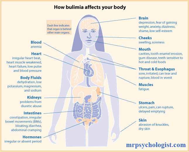 بولیمیا نروزا (Bulimia Nervosa) یا پرخوری عصبی همراه با جلوگیری